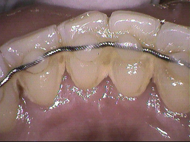 矯正後の保定装置まわりの歯石
