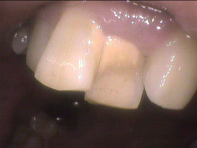 でこぼこの歯の表面の歯石