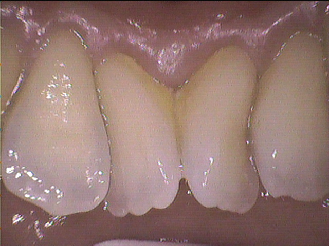 叢生歯のクリーニング