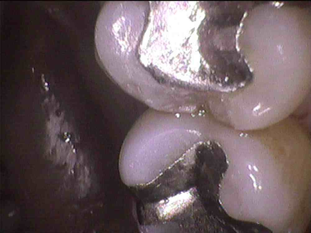 定期健診　気がつかない歯の破損