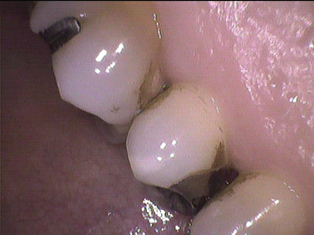歯と歯の間の着色汚れ
