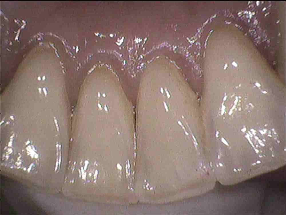 クリーニング　歯石除去・樹脂の変色
