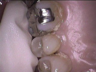 歯の裏の磨き残しとくさび状欠損