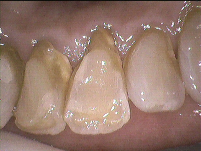 ３年ぶりの歯石除去