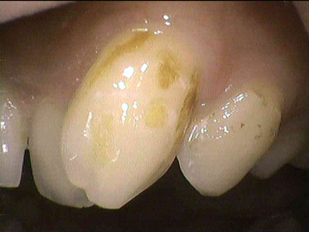 むし歯の始まり　脱灰と再石灰化