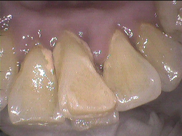 歯並びと歯周病