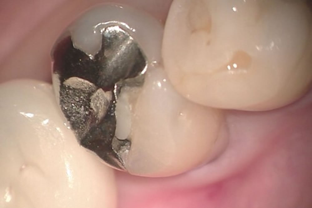 2次虫歯の治療