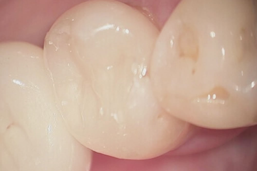 2次虫歯の治療